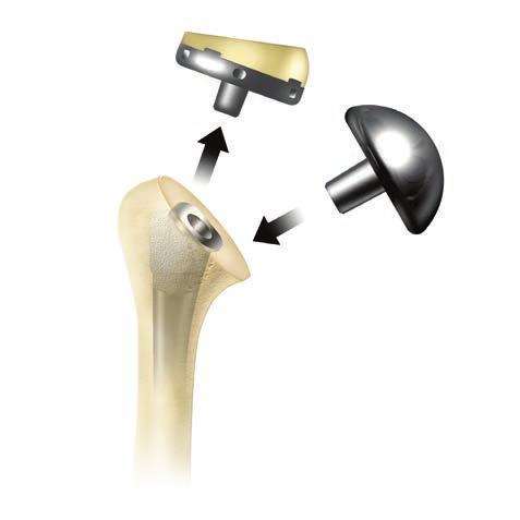 Comprehensive Reverse Shoulder System Figure 53 Figure 54 Central Post Removal Thread the guide rod onto the central post.