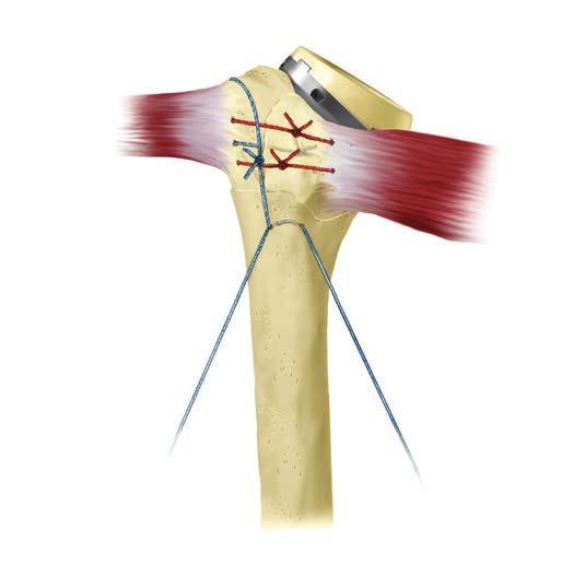 Figure 60 Figure 59 Figure 61 Pass the longitudinal suture, previously placed through the lateral hole in the humeral shaft, above the greater tuberosity.