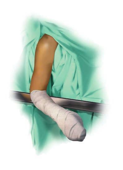 Patient Positioning and Incision Figure 1 Figure 2 Patient Positioning and Incision Surgical Position The arm and shoulder are prepped and draped free (Figure 1).
