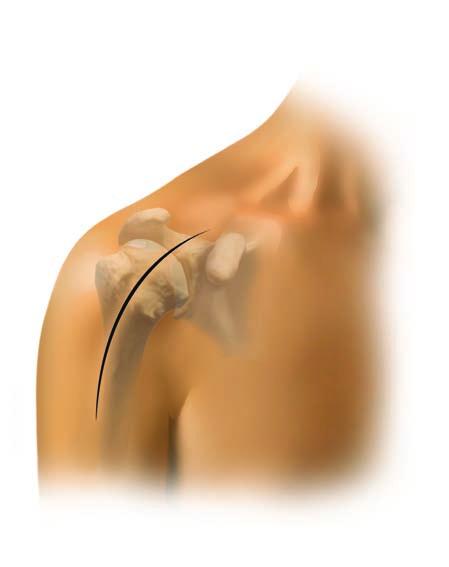 Surgical Incision/Exposure Utilize an extended deltopectoral anterior incision beginning immediately above the coracoid process and extending distally and laterally, following the deltopectoral