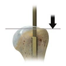 Insert the humeral reamer to the depths described below for the chosen stem. Continue reaming in 1 mm increments until cortical contact is achieved. Note the reamer size for future reference.