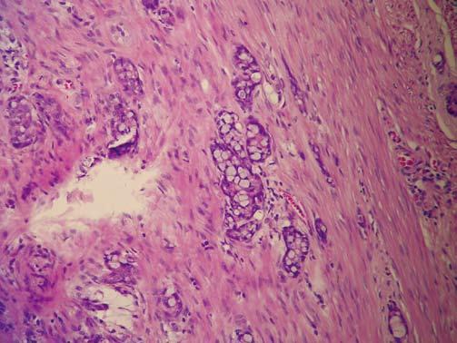 Appendiceal adenocarcinoma presenting with acute appendicitis 157 Fig. 2 Signet-ring shaped adenocarcinoma tumor cell (black arrow) is visible infiltrating through the muscularis wall.