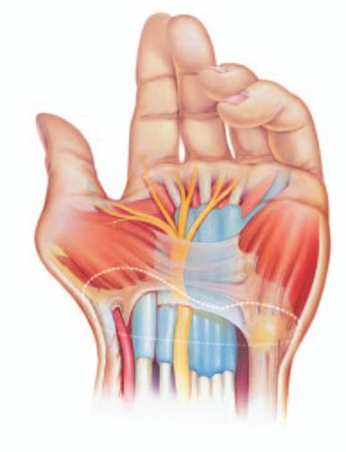 Open Surgery With open surgery, your surgeon makes one incision in your palm. Then he or she releases the transverse carpal ligament.