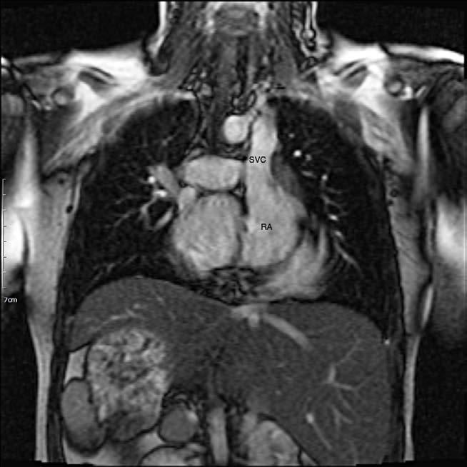 Thoracic aorta (A) descends on the right side.