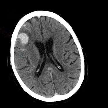 Blood in the brain and surrounding the brain detected by CT.