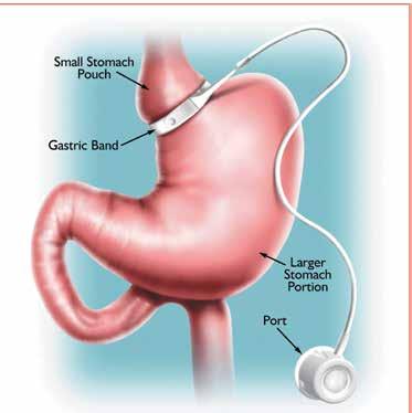 Non-metabolic Operations The options in this group provide significant weight-loss without altering the physiology of energy (fat) storage includes the laparoscopic adjustable gastric bands (LapBand