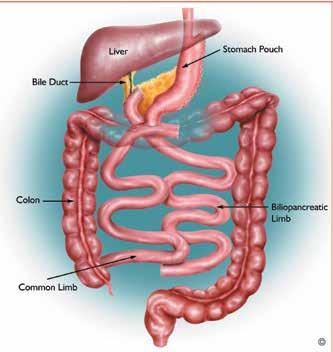 Roux-En-Y Gastric Bypass (RNYGB) Advantages: We have a great deal of experience with the RNYGB and know how to help patients with complications should they arise.