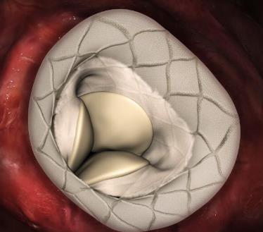 expanding outer frame, constant circular inner core Atrial component