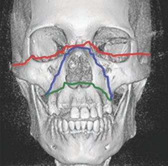 Assessing Language in Radiology and Surgery Reports of Facial Trauma fracture classifications, localizing descriptors for mandibular and orbital fractures also exist (Fig. 1).