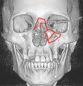 The radiologist s interpretation of the CT scan plays an important role in presurgical planning for patients with facial trauma.