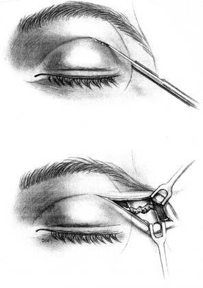 ii. Transconjunctival Incisions y Postcaruncular This incision is made vertically through the mucosa down to bone.