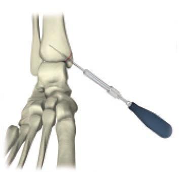 Select appropriate screw length. Length adjustment is particularly important if the tip is near an articular surface.