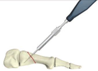 Select appropriate screw length. Length adjustment is particularly important if the tip is near an articular surface.