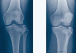 RESULTS Sixteen patients underwent surgery for correction of tibia plateau fractures at 6 different hospitals located in The Netherlands (Nieuwegein, Tilburg), Norway (Tønsberg), Spain (Madrid,