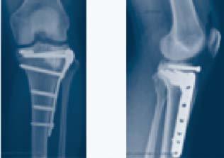 The majority of patients were female (6/10) and the age of patients varied from less than 40 to greater than 80 years of age. Most patients presented with a fracture of the left tibial plateau (6/10).