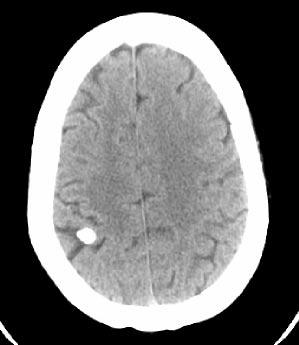 A B C D Figure 2. Neurocysticercosis.