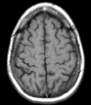MRI with (C) T1 hypointense and (D) T1-weighted postcontrast rim-enhancing lesion in the right postcentral cortex.