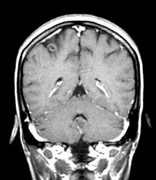 CT should be performed with contrast to assess for rim enhancement or other patterns. MRI is more useful than CT for brain abscess and likewise should be done with contrast enhancement.