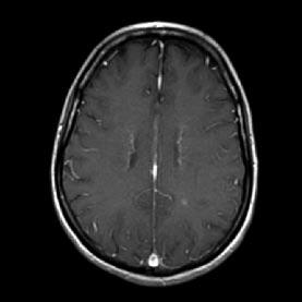 A Figure 3. Neurocysticercosis.
