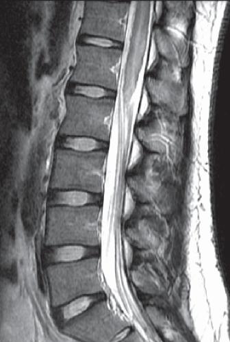 A C Figure 4. Spinal schistosomiasis. (A) Sagittal T2-weighted magnetic resonance image (MRI) showing intramedullary signal change in the conus and lower thoracic cord.