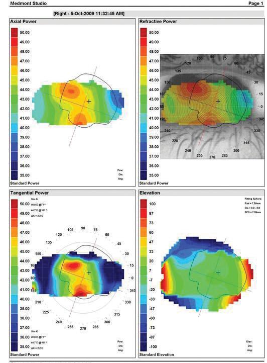 Figure 3: OD topography Figure 4. OS topography the patient was recommended to have an evaluation in the vision therapy service for further testing of his visual skills.