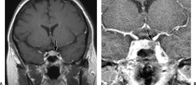 3T MRI AND CUSHING S DISEASE/KIM ET AL 275 RESULTS Imaging Outcomes Based on the 1.