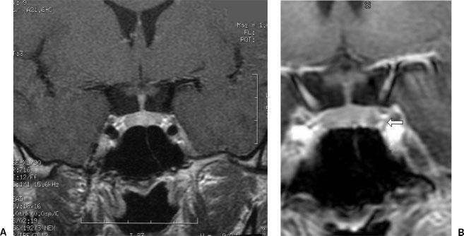 IPSS indicated a strong left-sided ACTH gradient with a high central-to-peripheral ratio. A left-sided ACTH-secreting adenoma was confirmed at surgery.