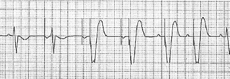 DDD Pacing in both the atrium and ventricle Sensing in both the atrium and ventricle Atrial lead T / I *