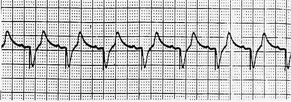 DDD pacing Example of sensing in the atrium (inhibition of atrial