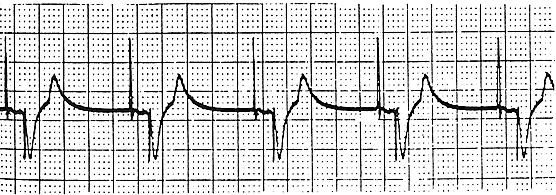 DDD pacing Example of atrial pacing and