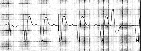 VDD Pacing in ventricle Sensing in both atrium and ventricle Atrial Lead Ventricular Lead T