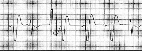 DOO Pacing in atrium and ventricle Intrinsic P wave and QRS do not affect pacing