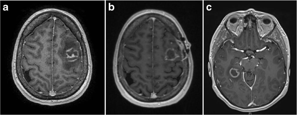 Sasson et al. BMC Infectious Diseases (2016) 16:457 Page 4 of 6 Fig. 1 Progressive cerebral toxoplasmosis on interval neuroimaging.