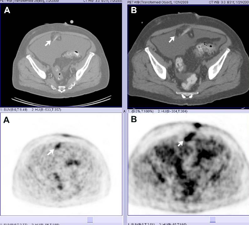 98 Imaging of PD Catheter Tunnel Infection FIGURE 1 Positron-emission tomography images showing increased activity along the abdominal wall portion of the peritoneal dialysis catheter.