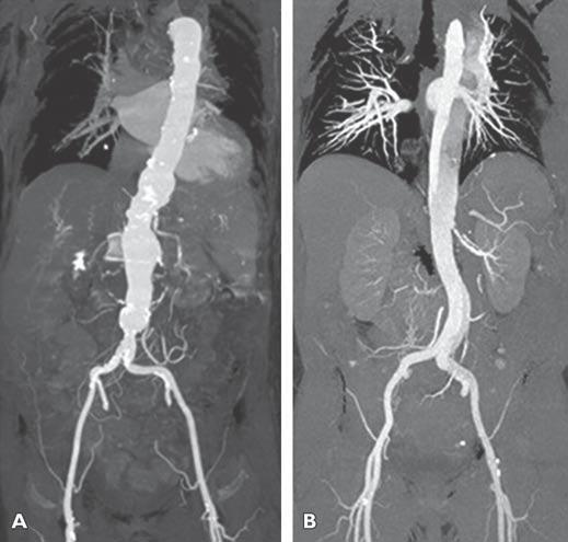 High-Pitch Versus Standard-Pitch CTA of the Aorta TABLE 2: Scanning Parameters for High-Pitch CT Angiography (CTA) and Standard-Pitch CTA Scanning Parameter High-Pitch CTA Group (n = 50)