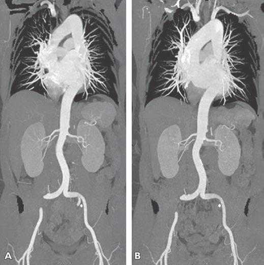 High-Pitch Versus Standard-Pitch CTA of the Aorta TABLE 4: Results of 20 Patients Who Underwent Both High-Pitch and Standard-Pitch CT Angiography (CTA) Parameter High-Pitch CTA Standard-Pitch CTA p