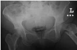 Figure 3: Postoperative AP plain radiograph of the left femur showing the PFNA in situ and confirming that the fracture had occurred through the area of previously demonstrated cortical beaking