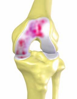 Understanding Osteoarthritis What are the symptoms of OA of the knee?