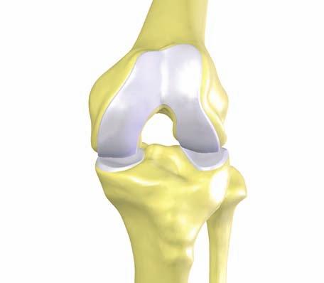 During this procedure, the natural joint is removed and replaced with an artificial implant. This treatment option is usually offered to patients with advanced osteoarthritis of the knee.