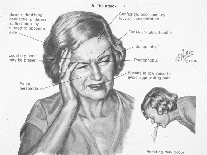 Migraine meeting IHS criteria (this is hard part) Episodic vestibular symptoms At least one of following during 2 attacks Migraine headache Photophobia Phonophobia