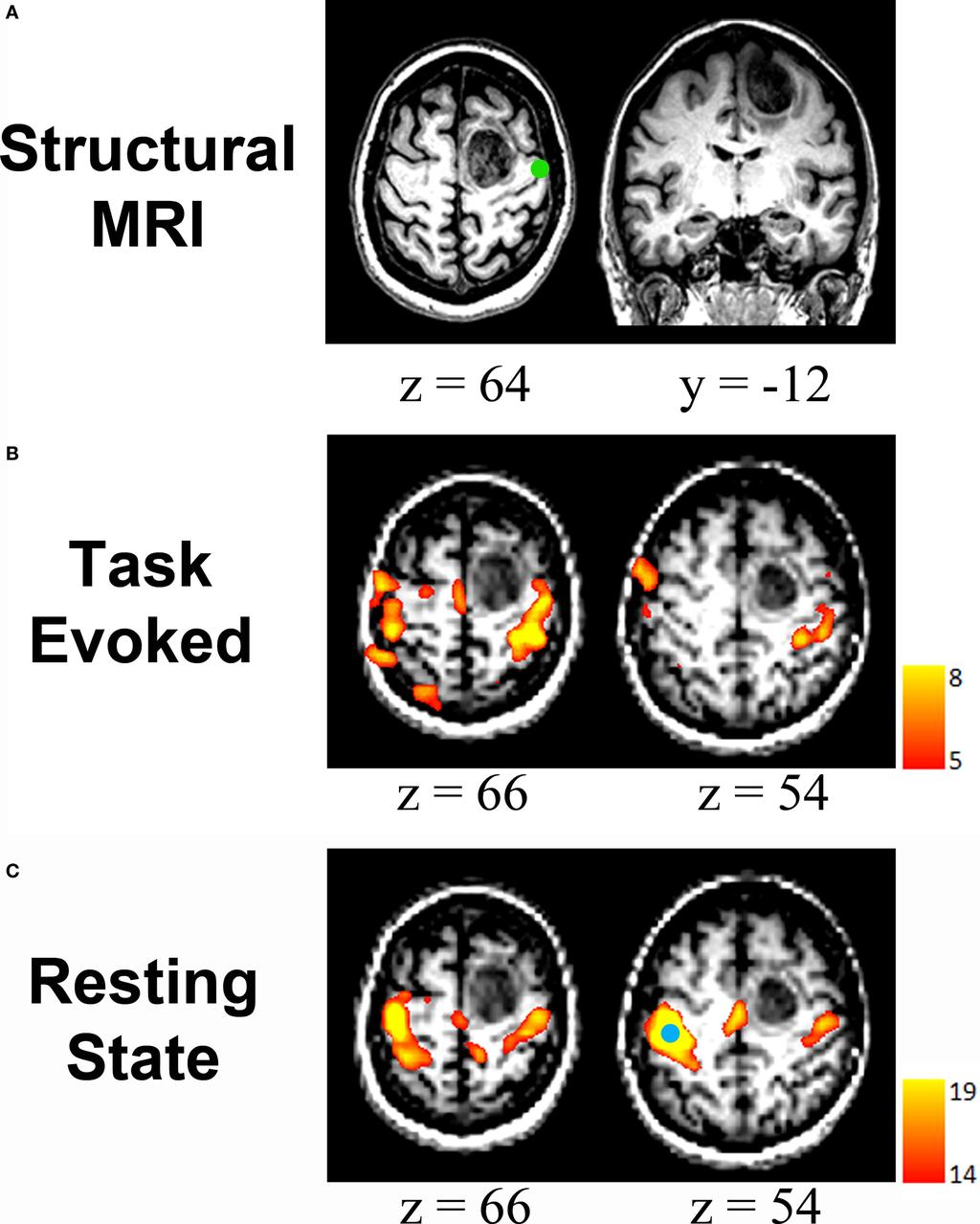 Figure 4 Resting state fcmri in pre-operative brain mapping: (A) Structural MRI scan showing a mass in the right frontal cortex.
