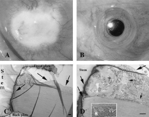 426 Dudenhoefer et al then entered a superficial cleft between stem and corneal graft stroma, but it extended posteriorly only to the point at which there was tight KPro cornea apposition.
