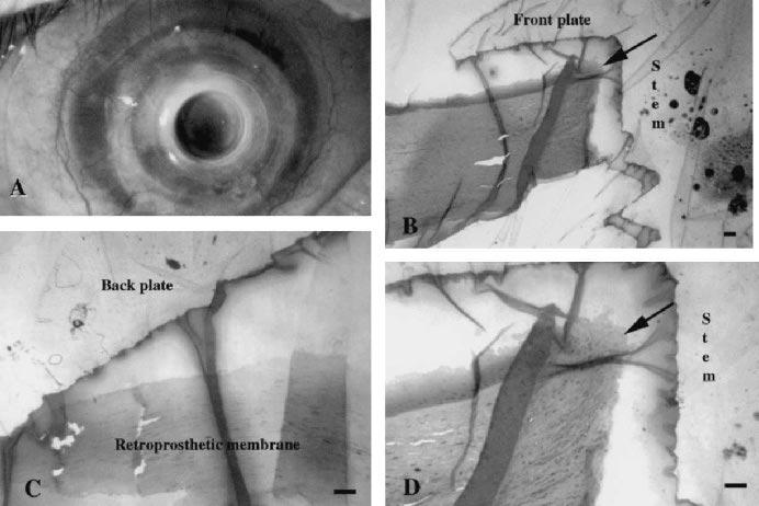 It appears that the corneal graft stroma holding the KPro had become somewhat reduced in thickness.