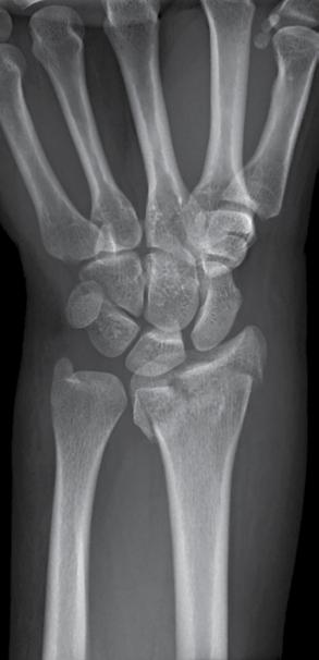 AO fracture classification: B3 Eben A.