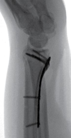 The patient underwent initial closed manipulation and reduction of her left distal radius fracture.
