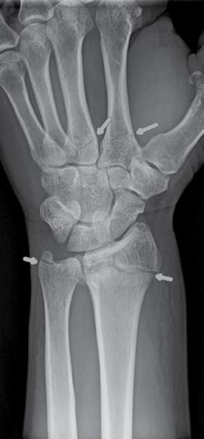 As a result, he sustained multiple fractures to his left hand and wrist including an intra-articular distal