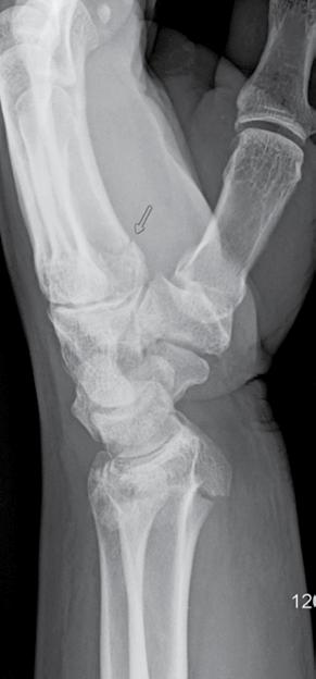 Fractures to the ulna and metacarpals were conservatively managed while it was decided to treat the distal