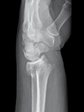 fracture of the right distal radius.