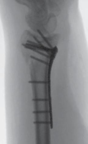 A volar approach was used to access the fracture site.
