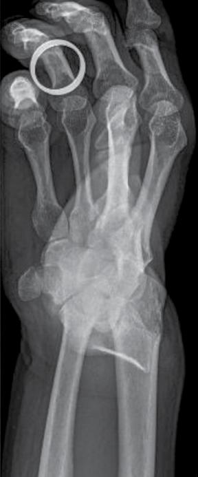 AO fracture classification: A3 Yngvar Krukhaug, MD, PhD Orthopaedic Senior Consultant Bergen, Norway A